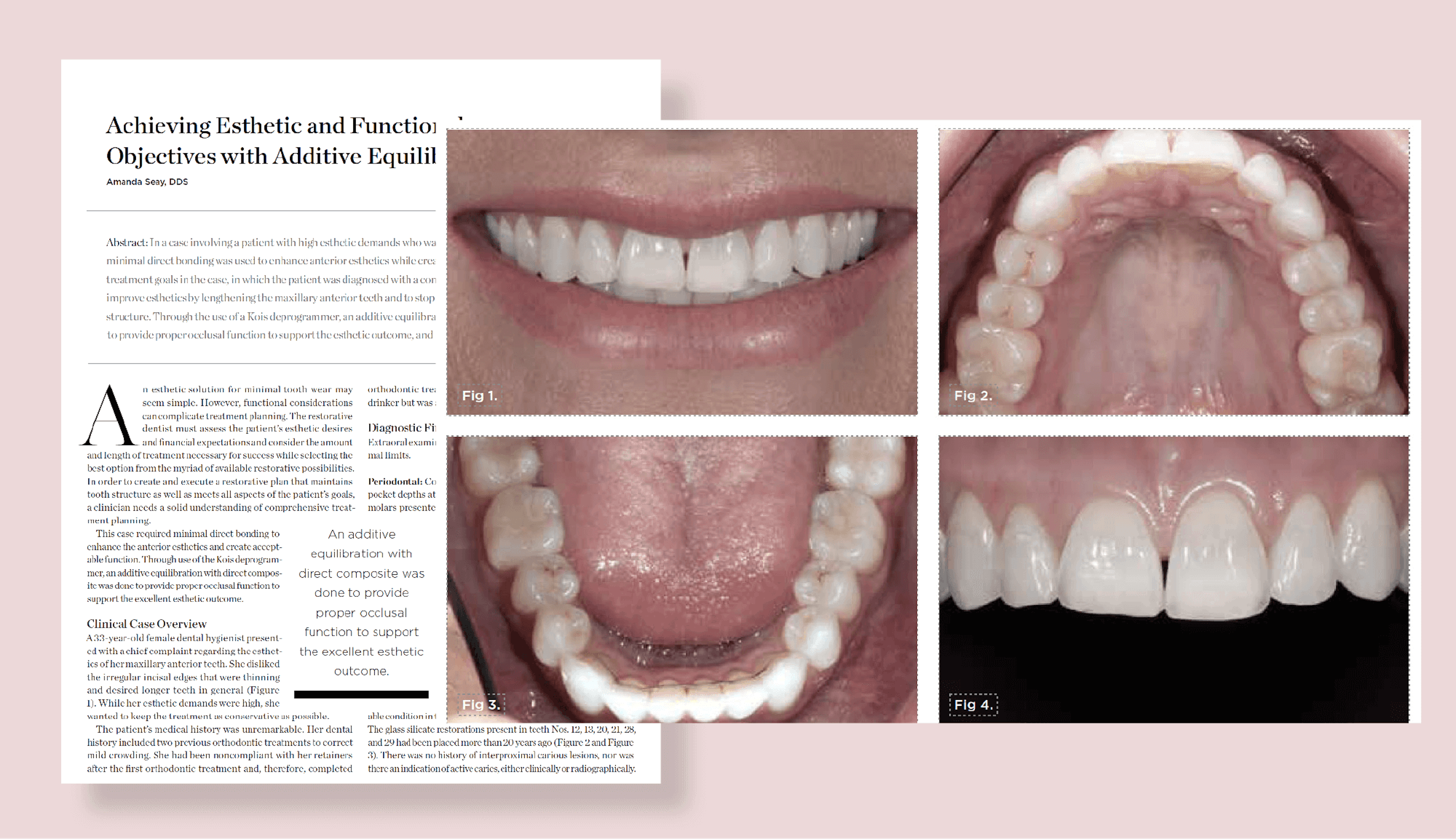 Achieving Esthetic and Functional Objectives with Additive Equilibration