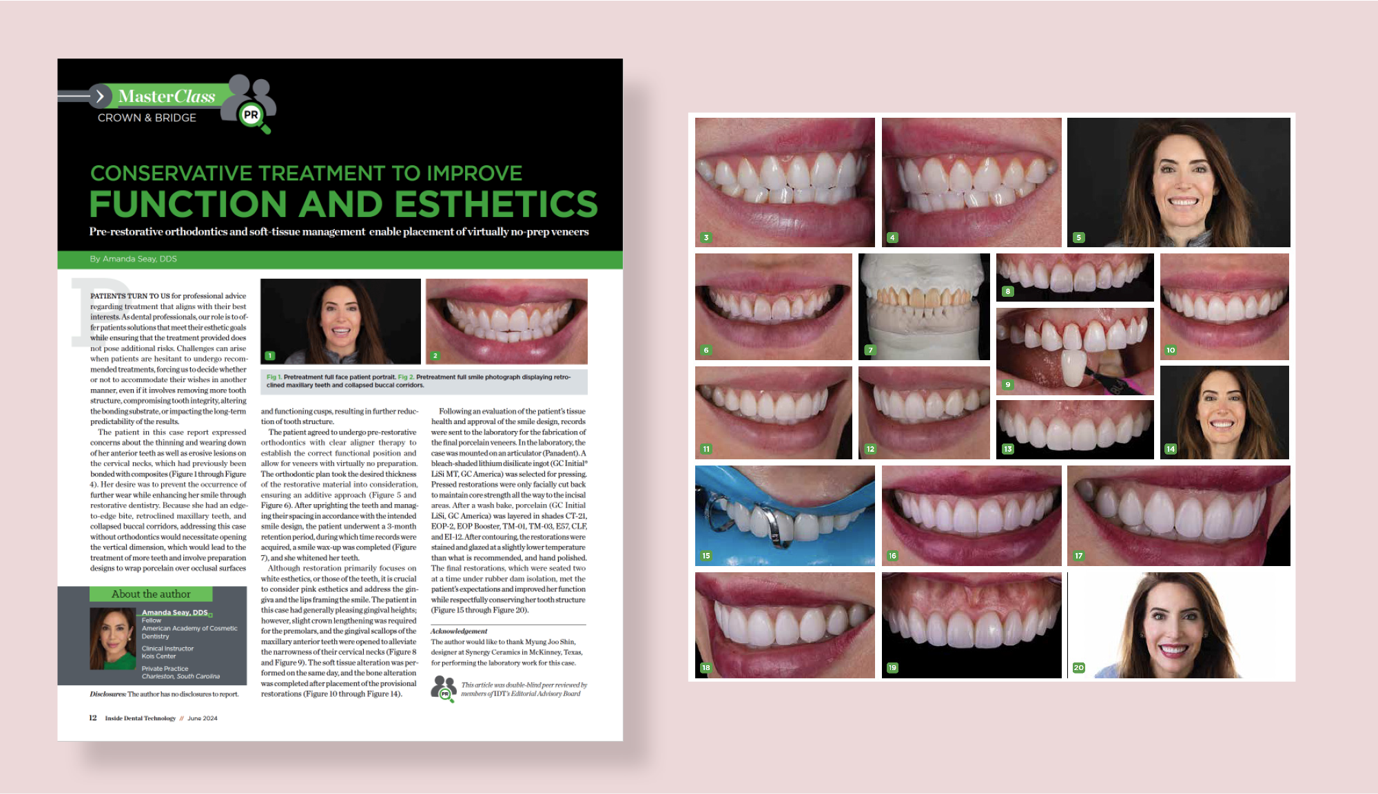 Conservative Treatment to Improve Function & Esthetics