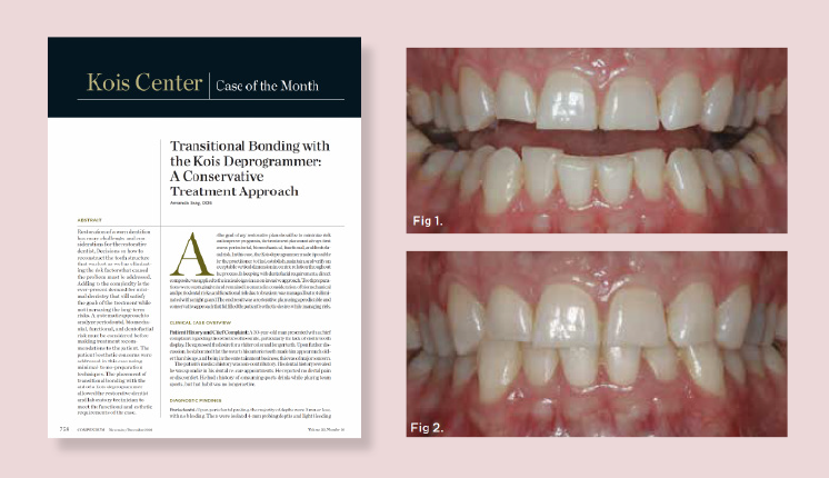 Transitional Bonding with Kois Deprogrammer: A Conservative Treatment Approach